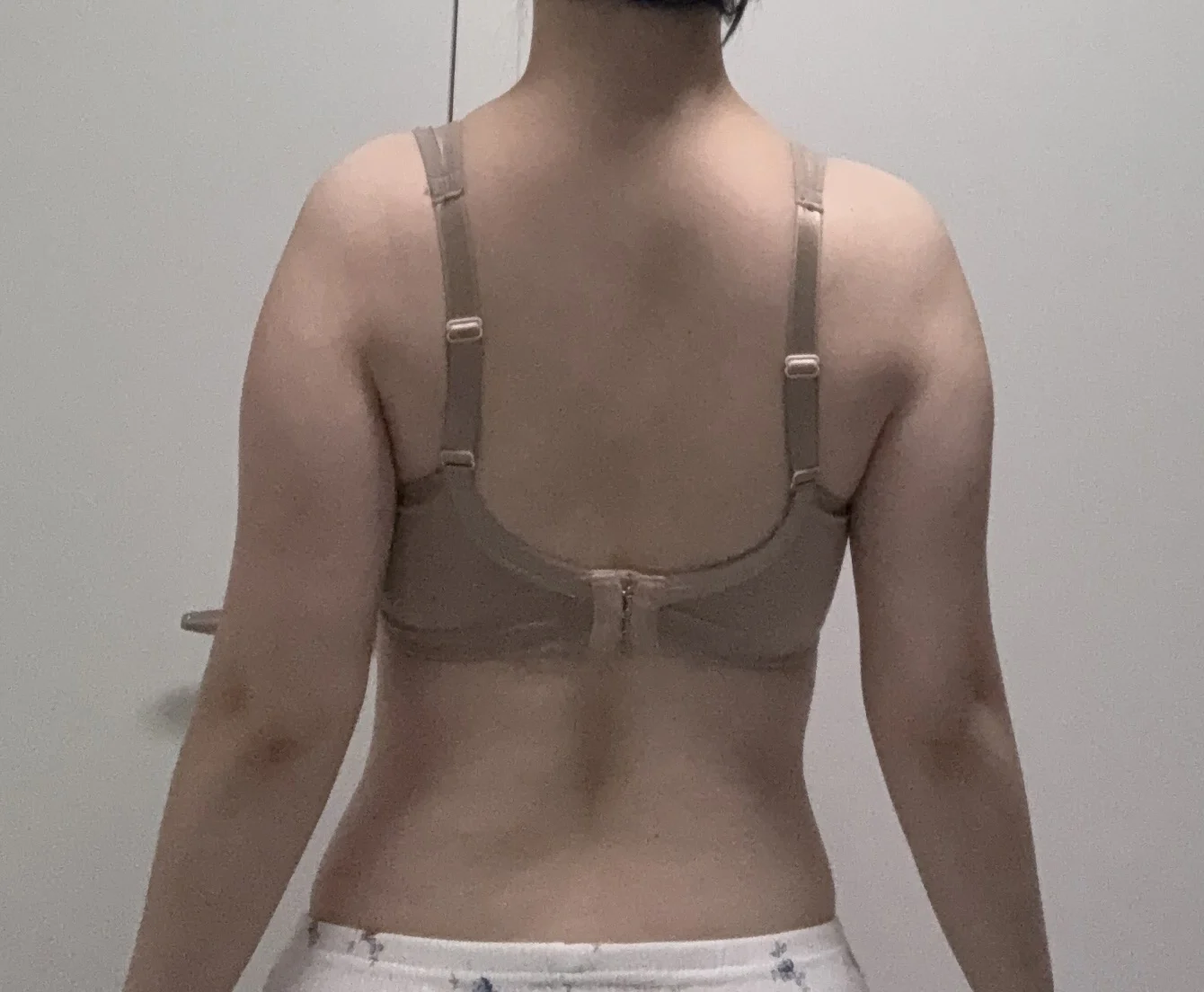 My one-month arm lipo review! - Arm Liposuction Before 2 - TheLINE Plastic Surgery