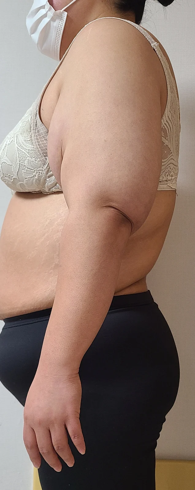 One month after arm liposuction and arm  - Body Contouring Before 2 - TheLINE Plastic Surgery