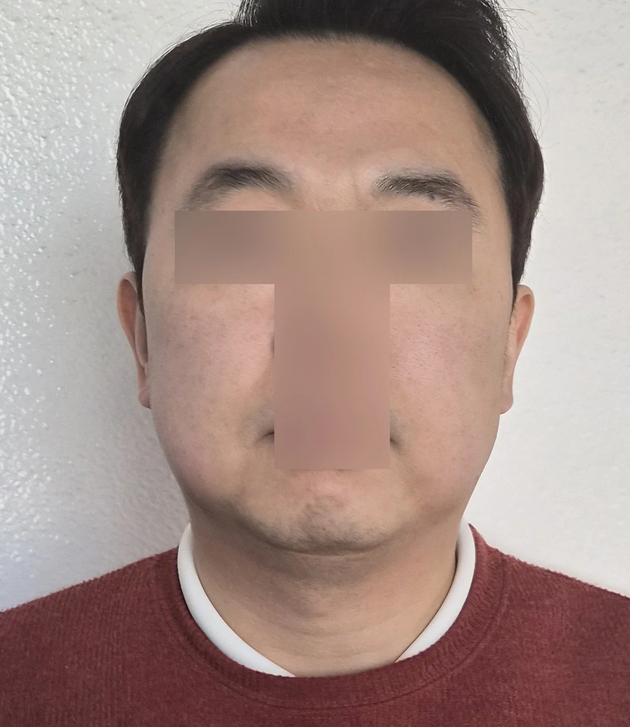 I had facial liposuction on my cheeks an - Facial Liposuction Before 2 - TheLINE Plastic Surgery