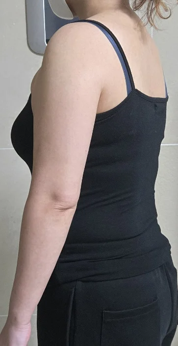 The arm liposuction scars aren't visible - Arm Liposuction Before 2 - TheLINE Plastic Surgery