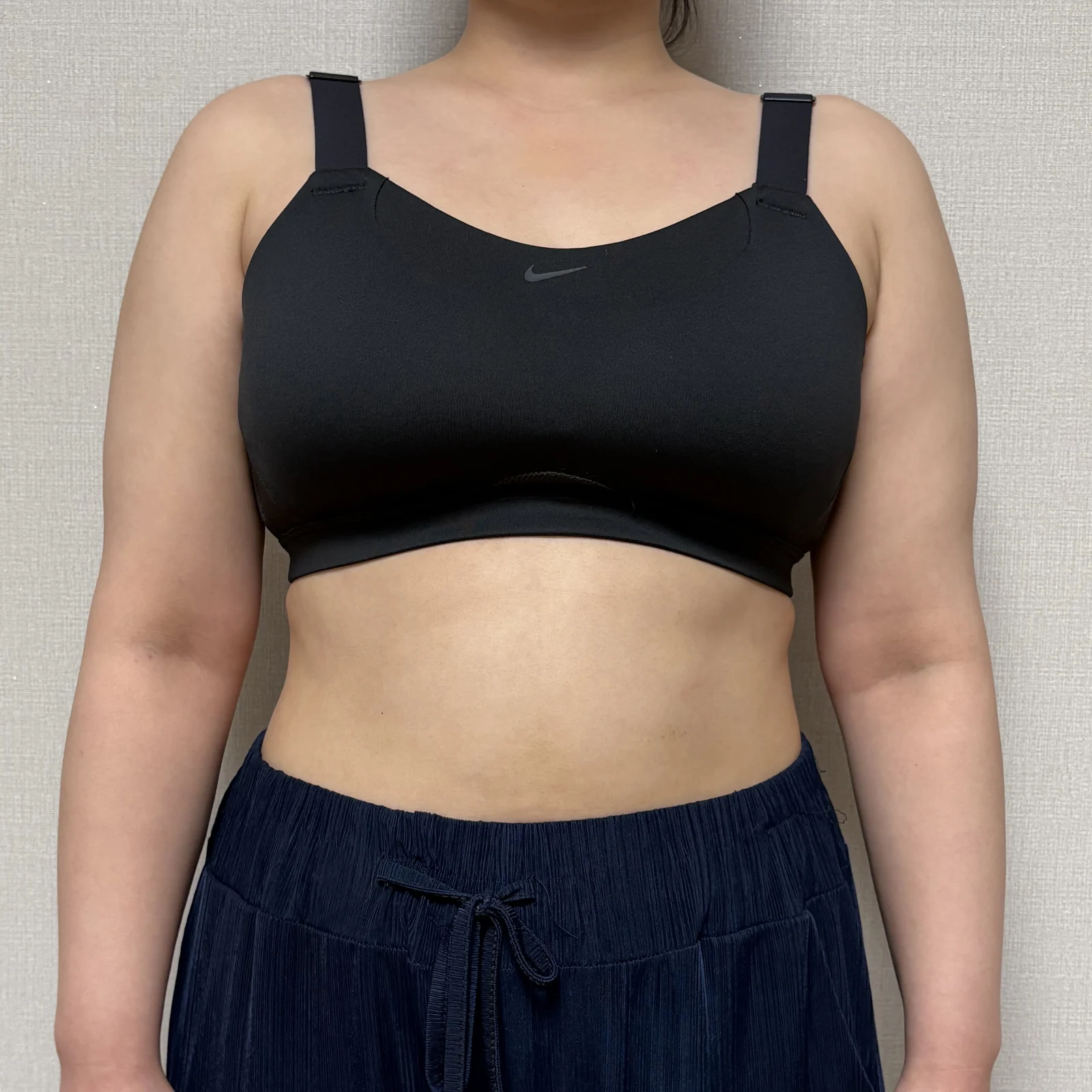 Three months after arm liposuction!! - Arm Liposuction Before 2 - TheLINE Plastic Surgery