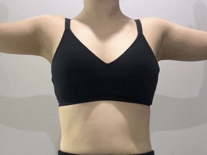 I had liposuction with Dr. Jaeho Cho - Arm Liposuction surgery Before photo - TheLINE Plastic Surgery