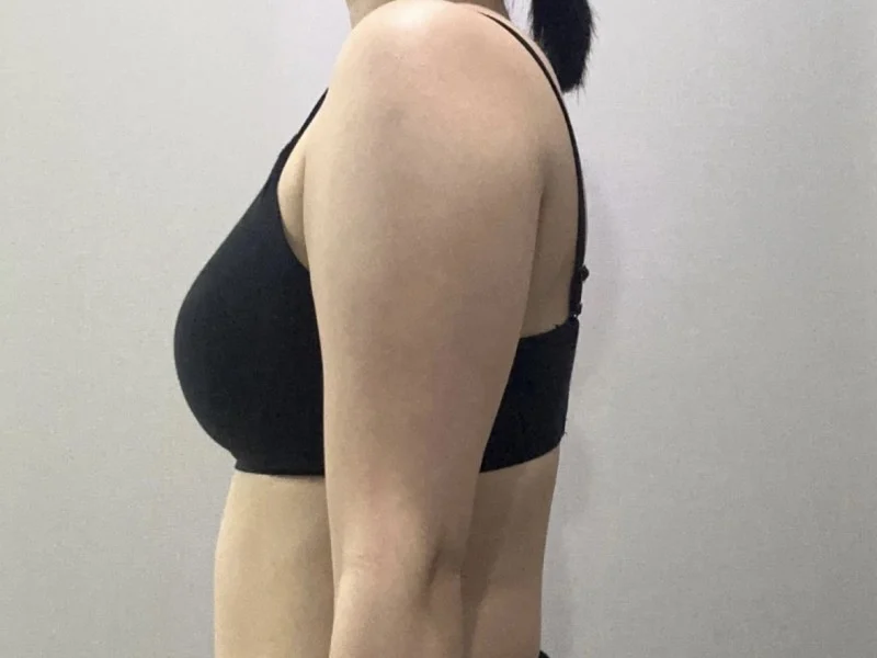I had liposuction with Dr. Jaeho Cho - Arm Liposuction Before 2 - TheLINE Plastic Surgery