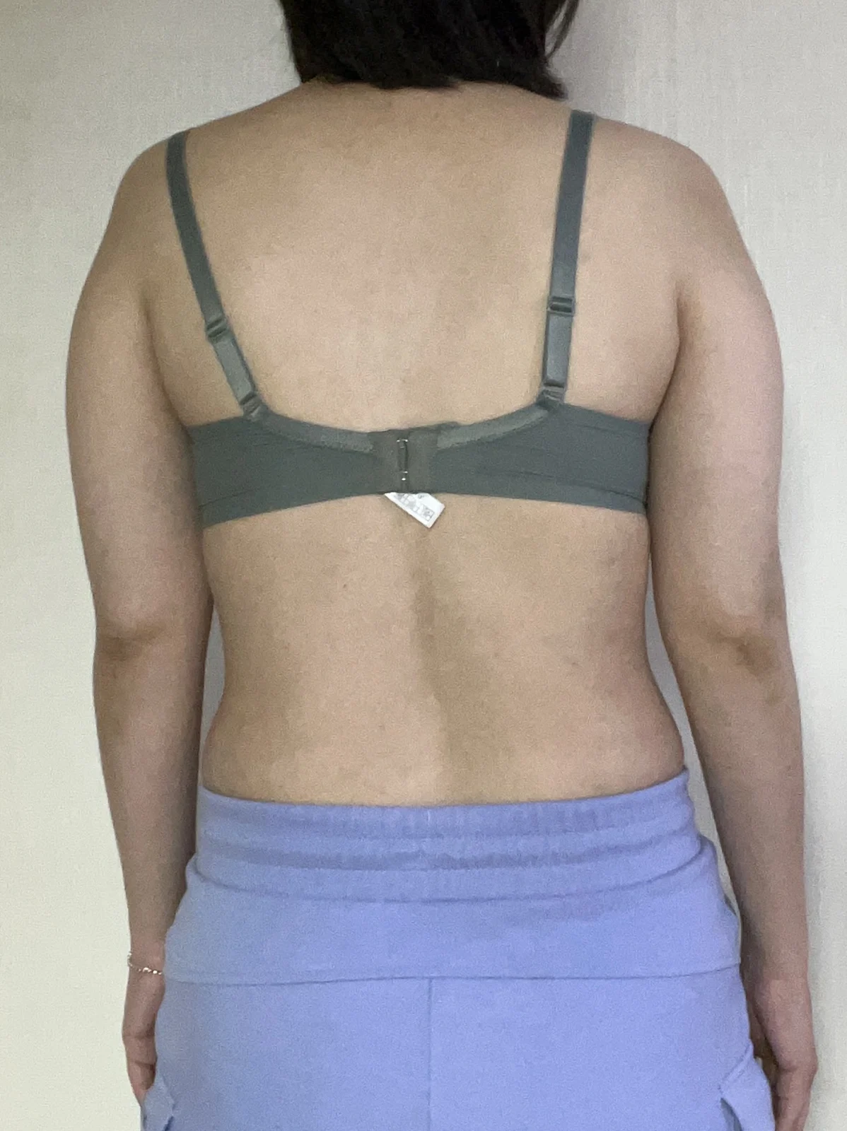 6 months after arm liposuction - Arm Liposuction Before 2 - TheLINE Plastic Surgery