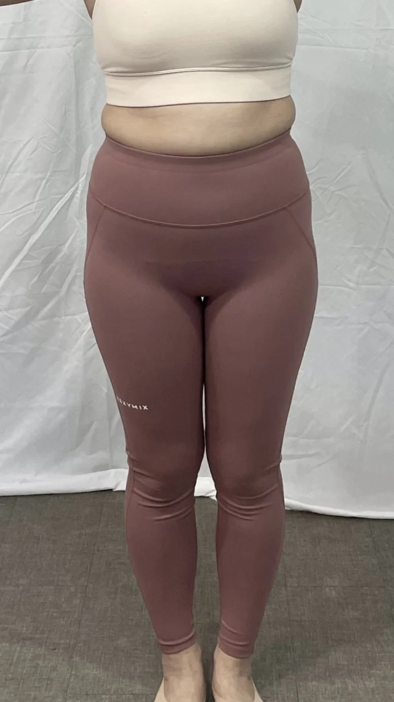 My contour got prettier - Hip Fat Grafting surgery Before photo - TheLINE Plastic Surgery