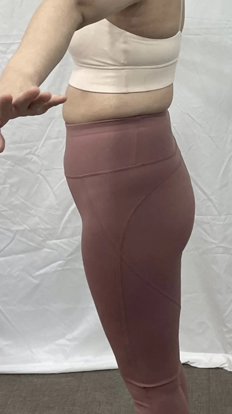 My contour got prettier - Hip Fat Grafting Before 2 - TheLINE Plastic Surgery