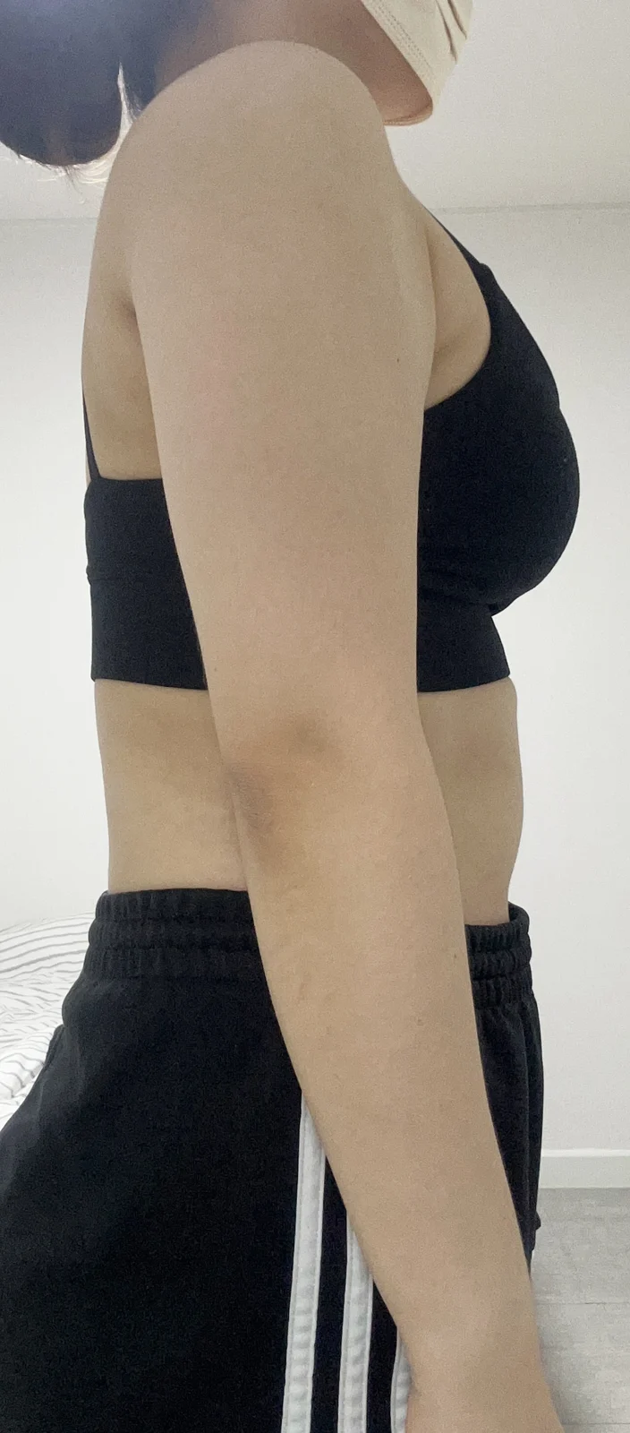 6 months free of upper arm and accessory - Arm Liposuction Before 2 - TheLINE Plastic Surgery
