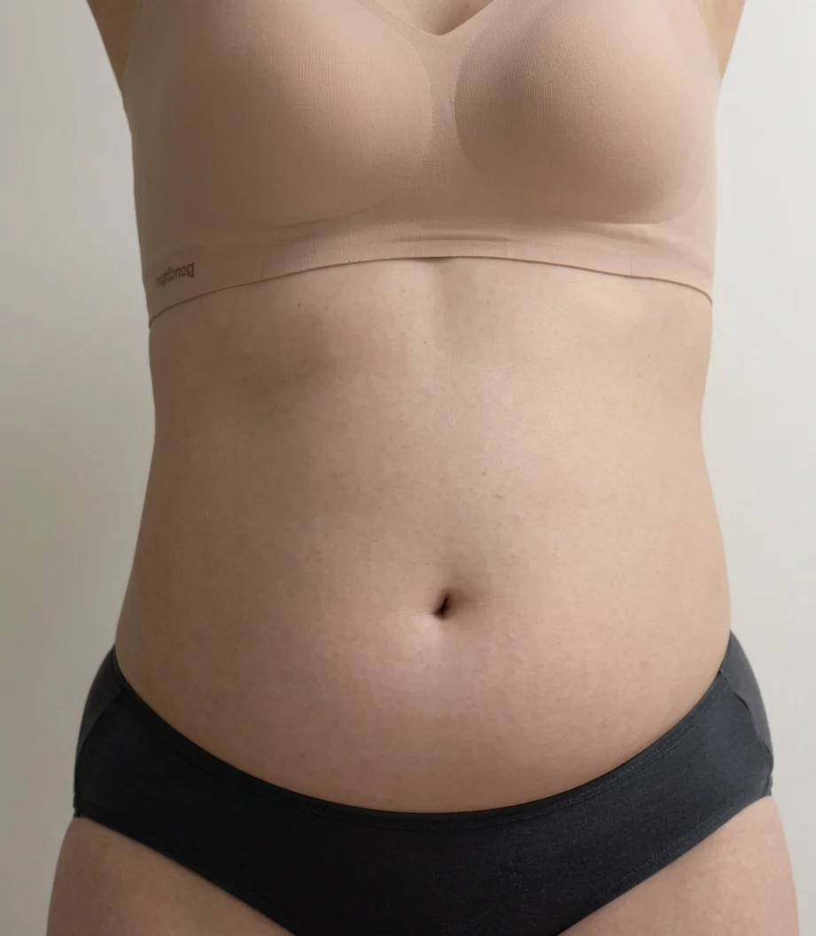3 months after abdomen and love handle s - Abdominal Liposuction (Upper Body) Before 2 - TheLINE Plastic Surgery
