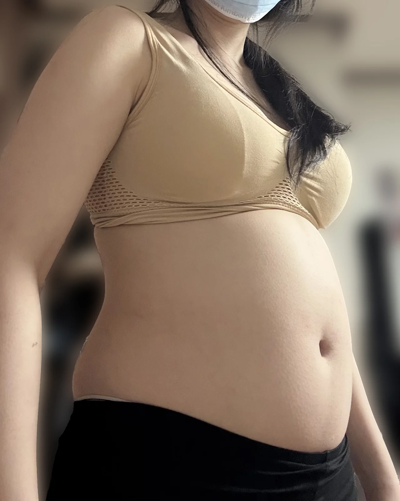 My review of abdomen + love handle + bra - Abdominal Liposuction (Upper Body) Before 2 - TheLINE Plastic Surgery