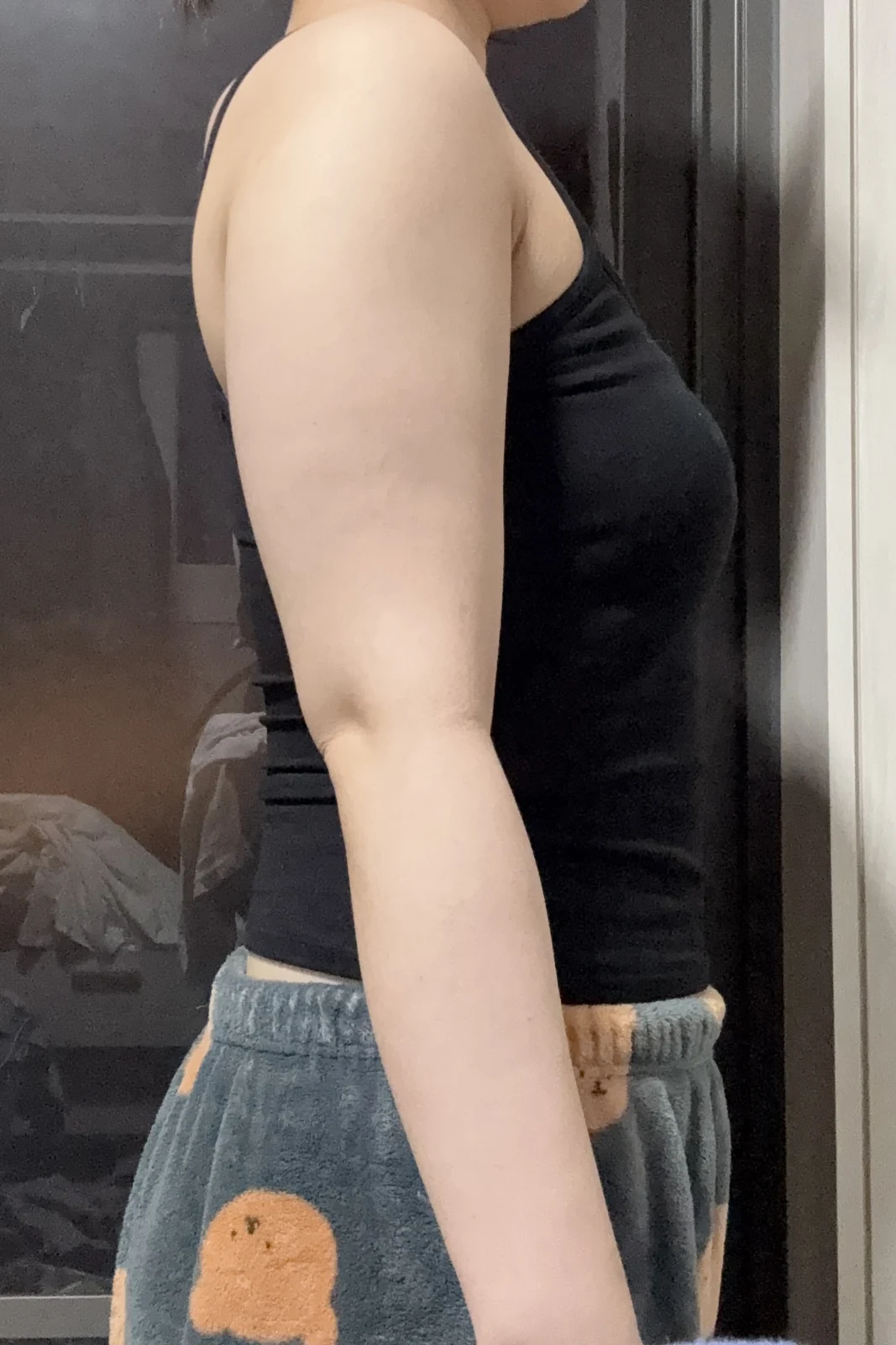 One-month review of arm and accessory br - Arm Liposuction Before 2 - TheLINE Plastic Surgery