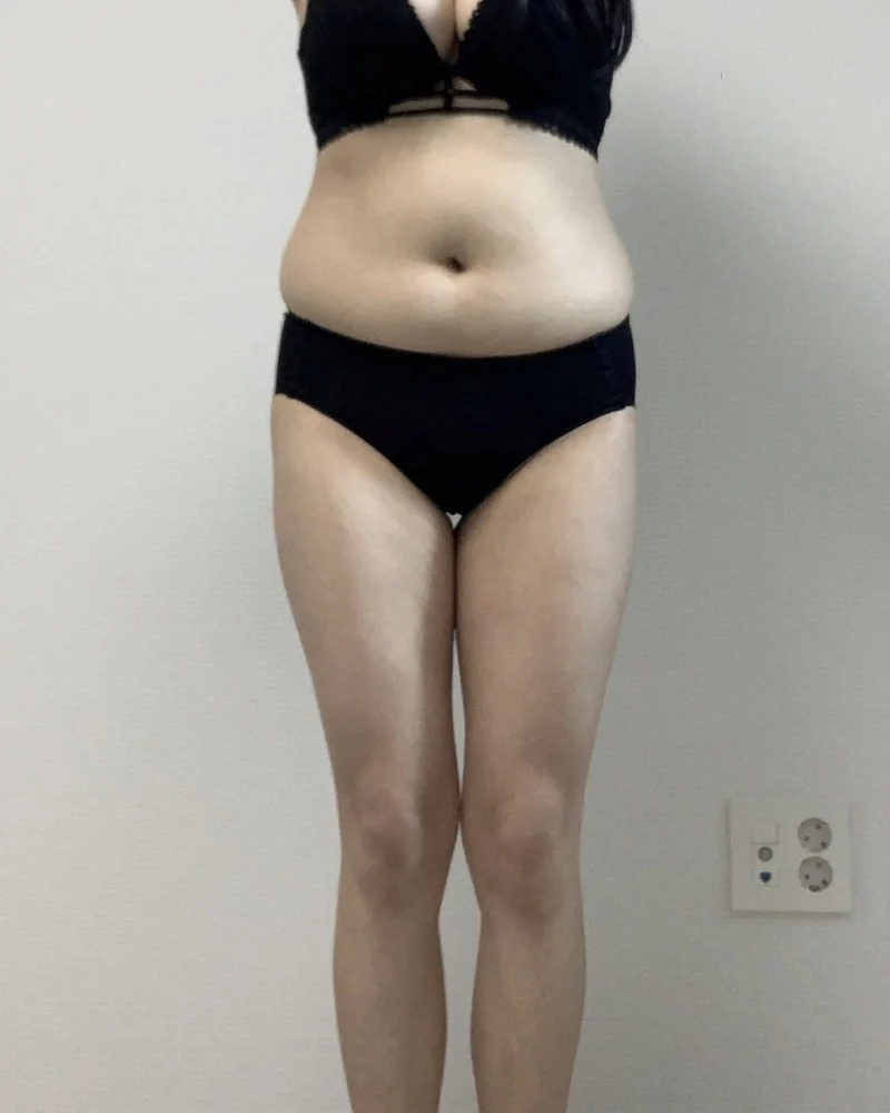 I love TheLINE - Hip Fat Grafting Before 2 - TheLINE Plastic Surgery