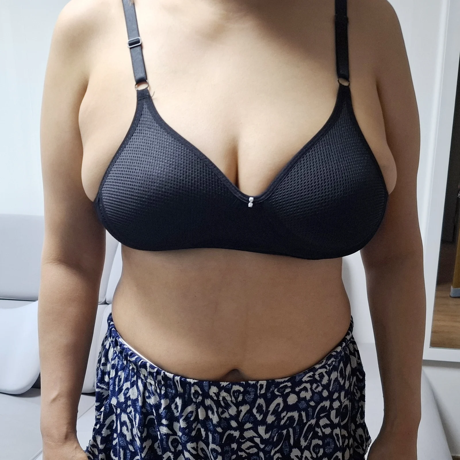One month after breast liposuction + red - Body Contouring Before 2 - TheLINE Plastic Surgery