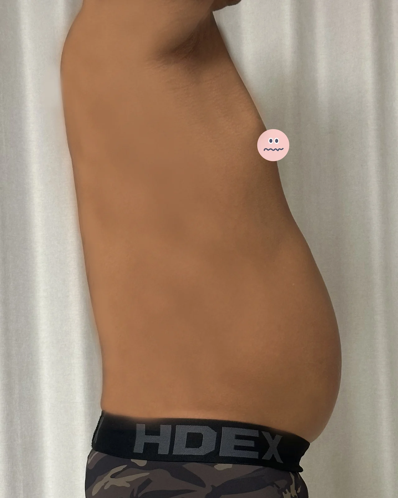 Hello. Posting my 6-month abdominal lipo - Abdominal Liposuction (Upper Body) Before 2 - TheLINE Plastic Surgery
