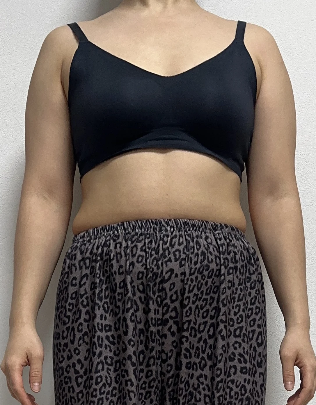 I had arm liposuction with Dr. Joongjae - Arm Liposuction surgery Before photo - TheLINE Plastic Surgery