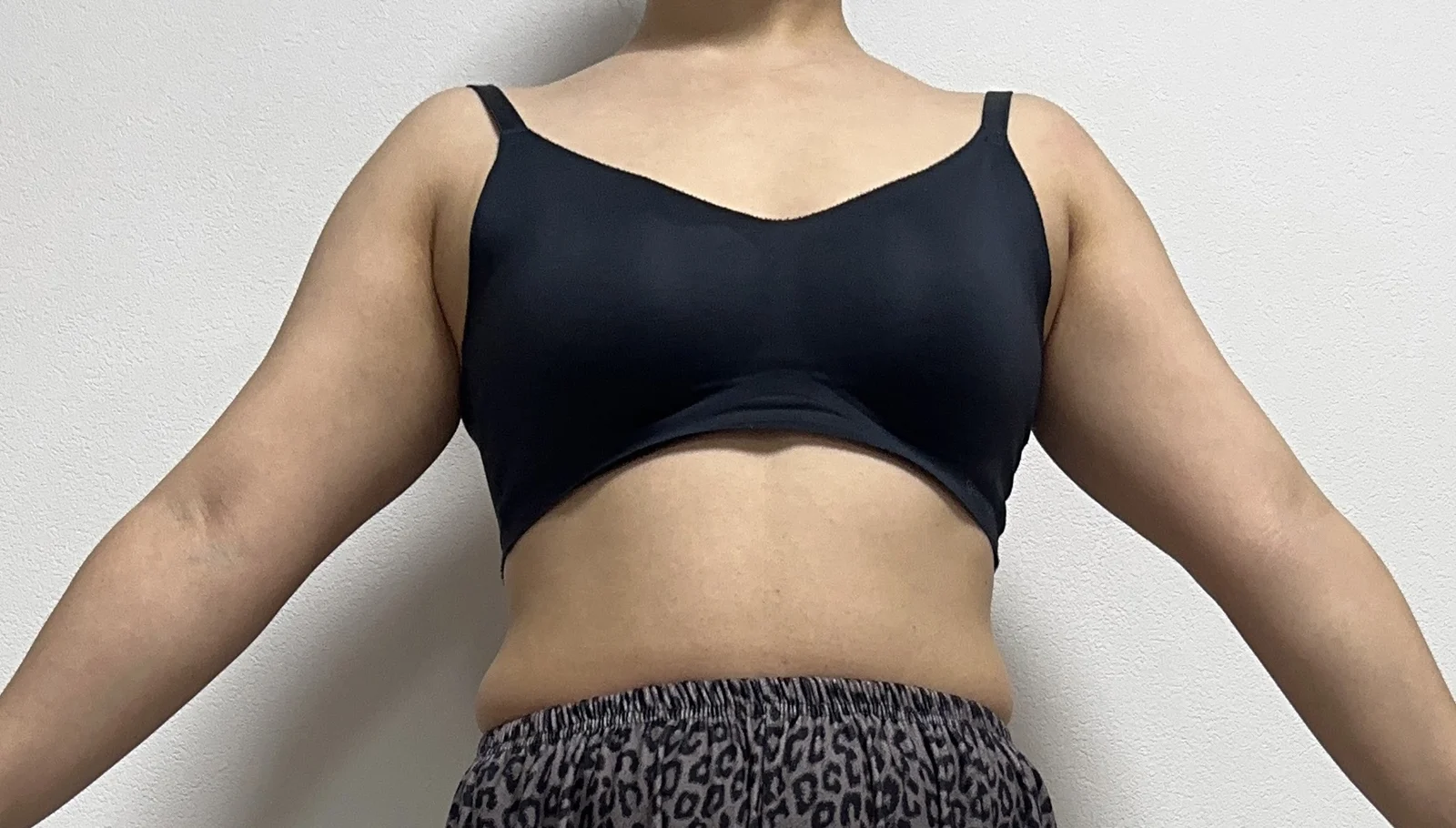 I had arm liposuction with Dr. Joongjae  - Arm Liposuction Before 2 - TheLINE Plastic Surgery
