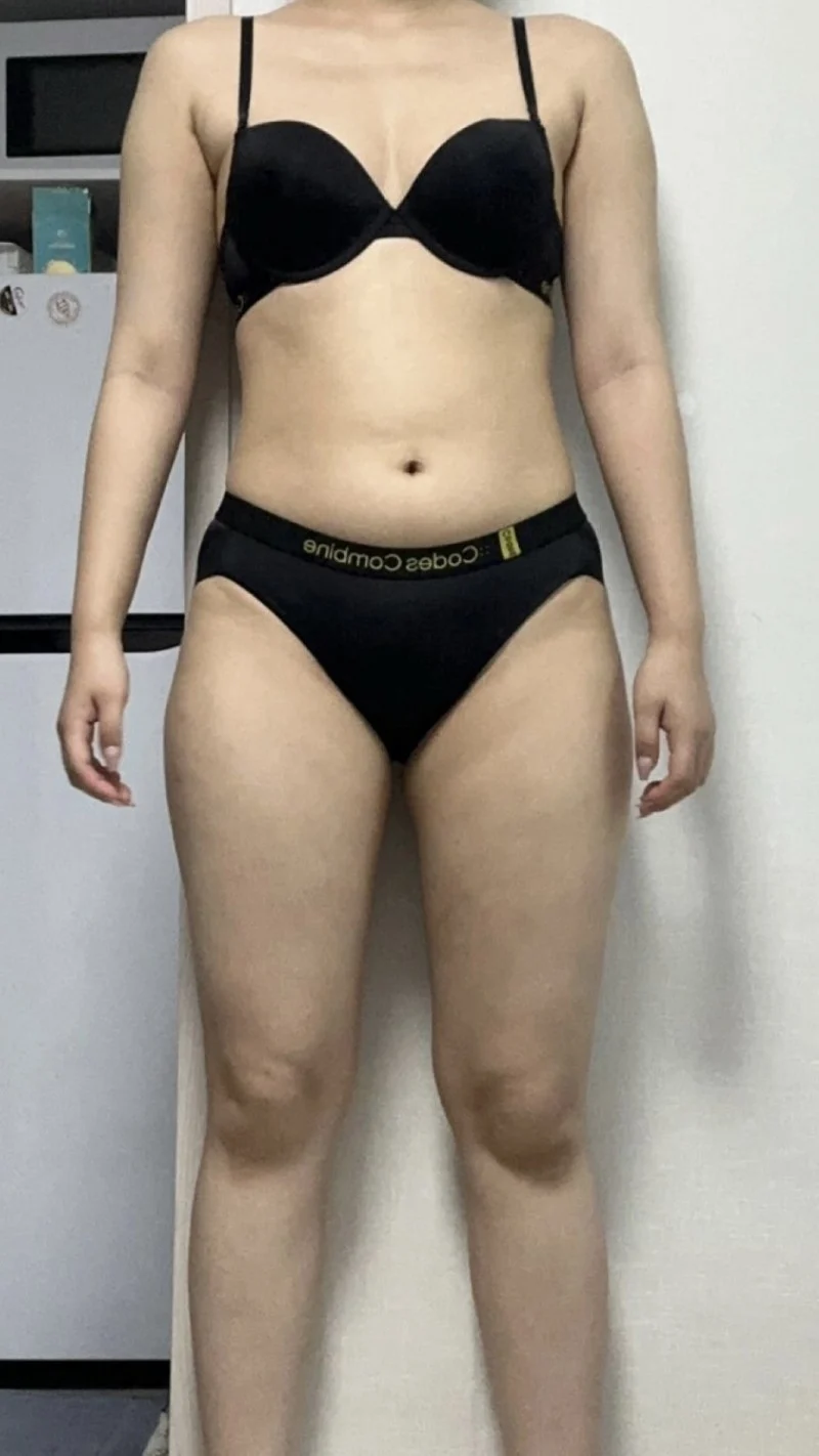 Stem cell waist-to-saddlebags - Abdominal Liposuction (Upper Body) surgery Before photo - TheLINE Plastic Surgery