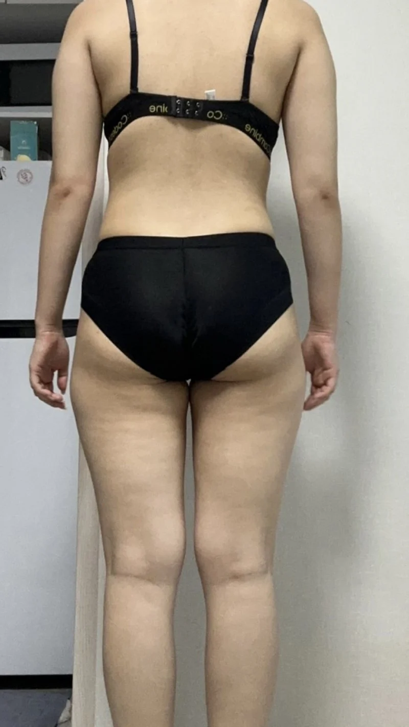 Stem cell waist-to-saddlebags - Abdominal Liposuction (Upper Body) Before 2 - TheLINE Plastic Surgery
