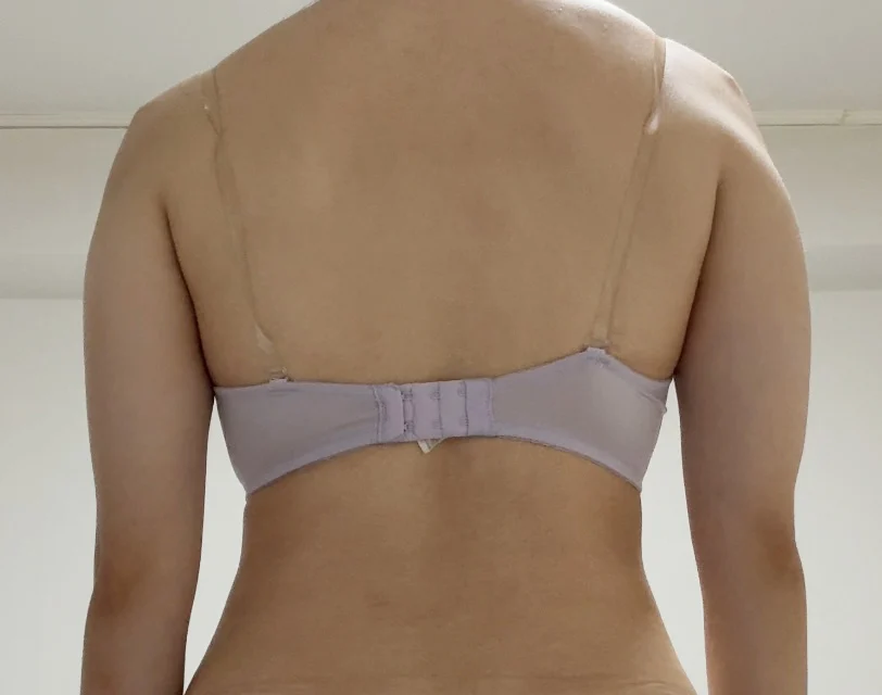 Hello! This is my 6-month review ^^ - Arm Liposuction surgery Before photo - TheLINE Plastic Surgery