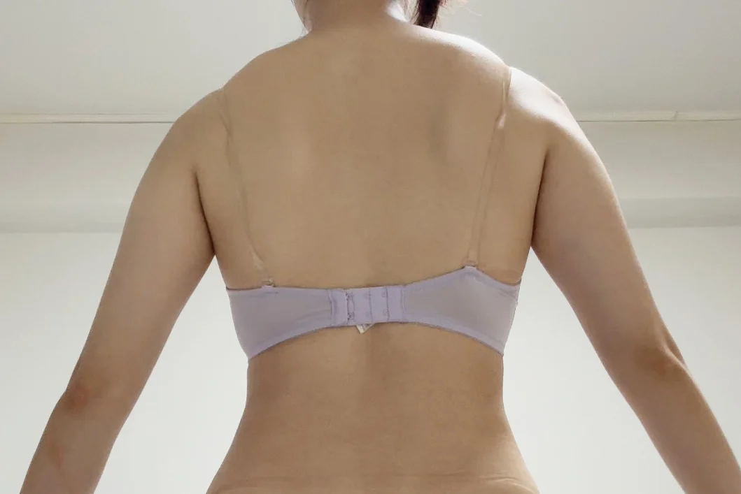 Hello! This is my 6-month review ^^ - Arm Liposuction Before 2 - TheLINE Plastic Surgery