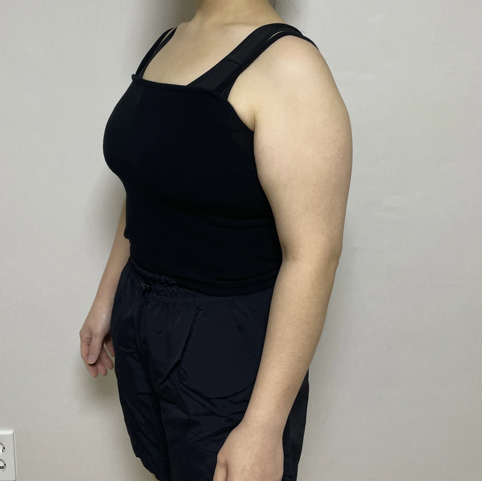 3 months after my arm lift and arm lipos - Body Contouring Before 2 - TheLINE Plastic Surgery