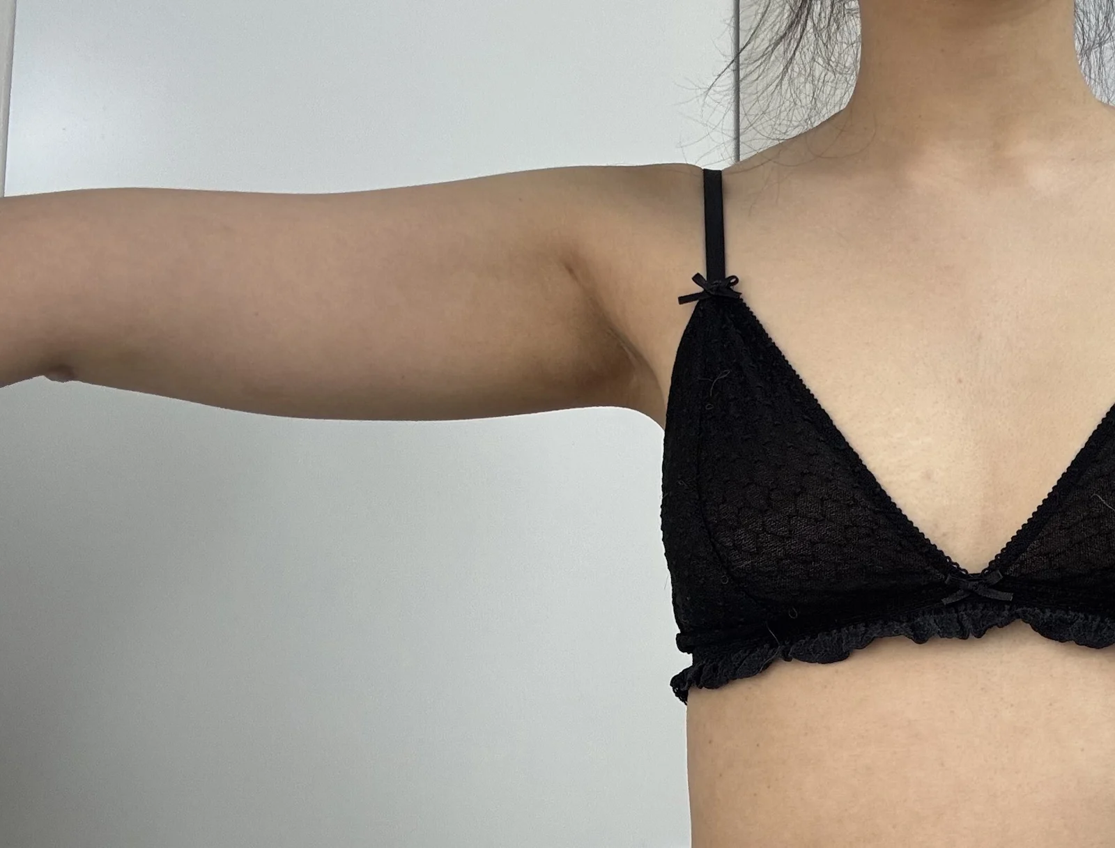 I had arm and accessory breast lipo~~ - Arm Liposuction Before 2 - TheLINE Plastic Surgery