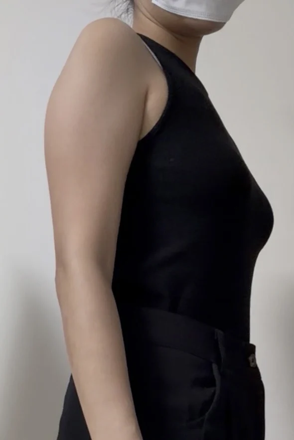 I had arm liposuction with Dr. Yoosuk Ch - Arm Liposuction Before 2 - TheLINE Plastic Surgery