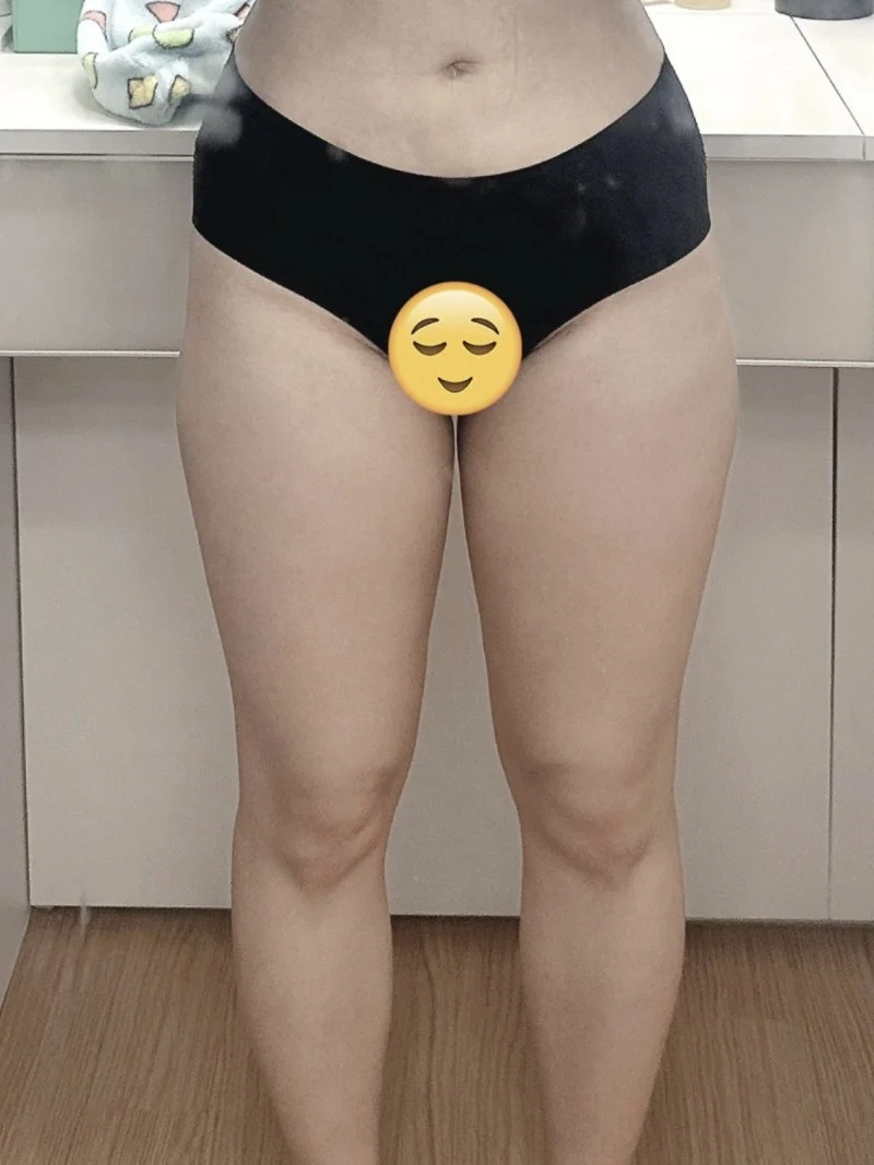 My quality of life went way up - Thigh Liposuction (Lower Body) Before 2 - TheLINE Plastic Surgery