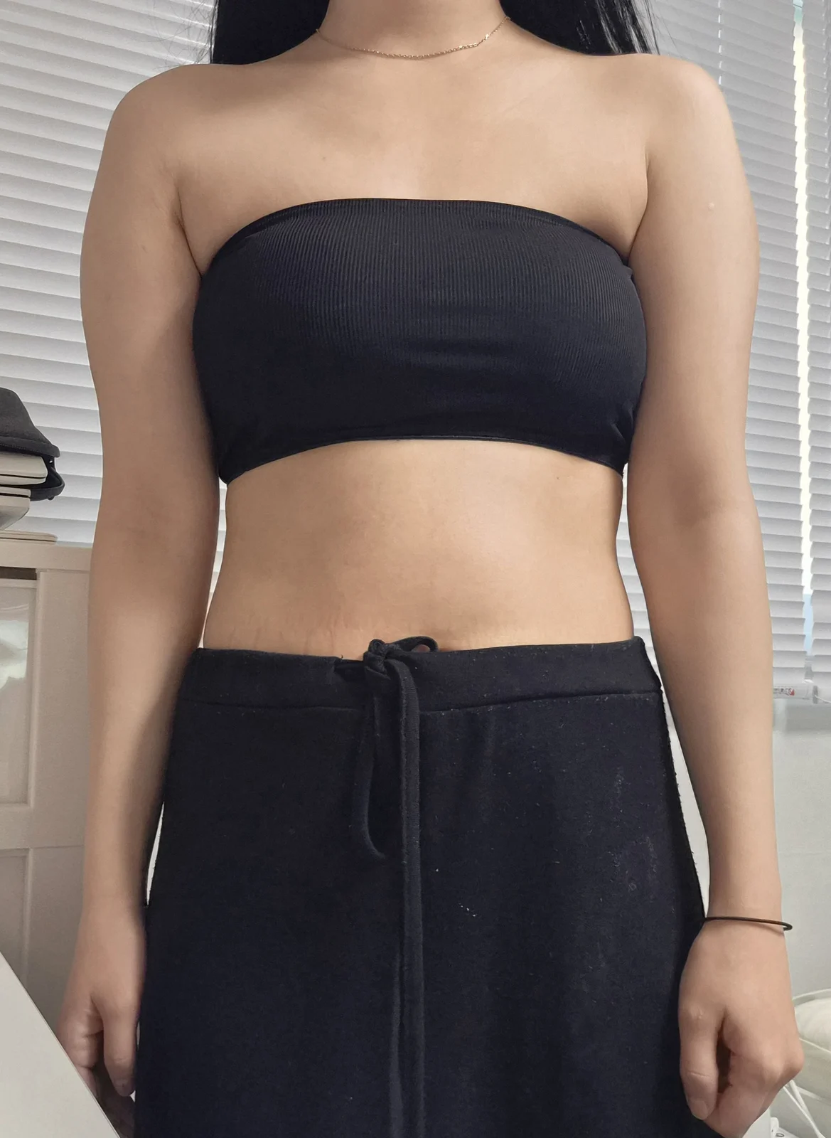 Already one month after arm liposuction! - Arm Liposuction Before 2 - TheLINE Plastic Surgery