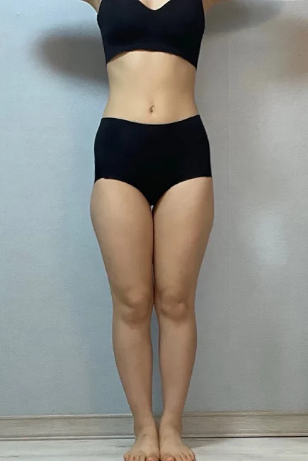 Waist to saddlebags review - Hip Fat Grafting Before 2 - TheLINE Plastic Surgery