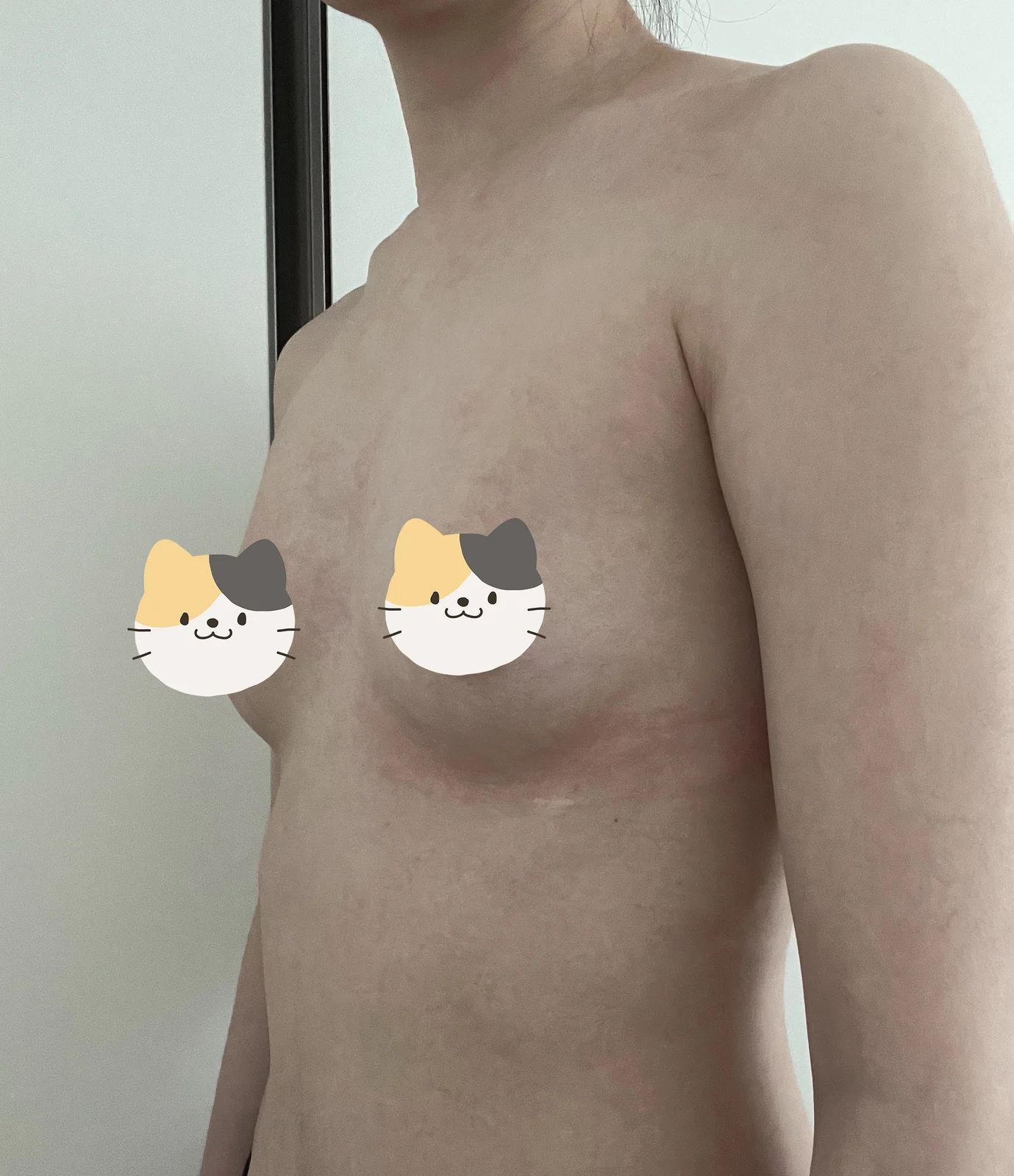 I've had breast fat grafting through a s - Breast Fat Grafting Before 2 - TheLINE Plastic Surgery