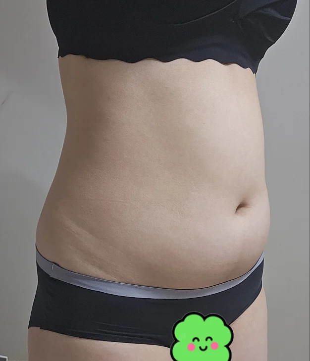 Posting my surgery review! - Abdominal Liposuction (Upper Body) Before 2 - TheLINE Plastic Surgery