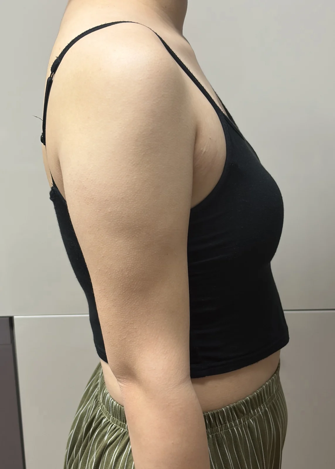 Arm and upper arm root liposuction revie - Arm Liposuction Before 2 - TheLINE Plastic Surgery