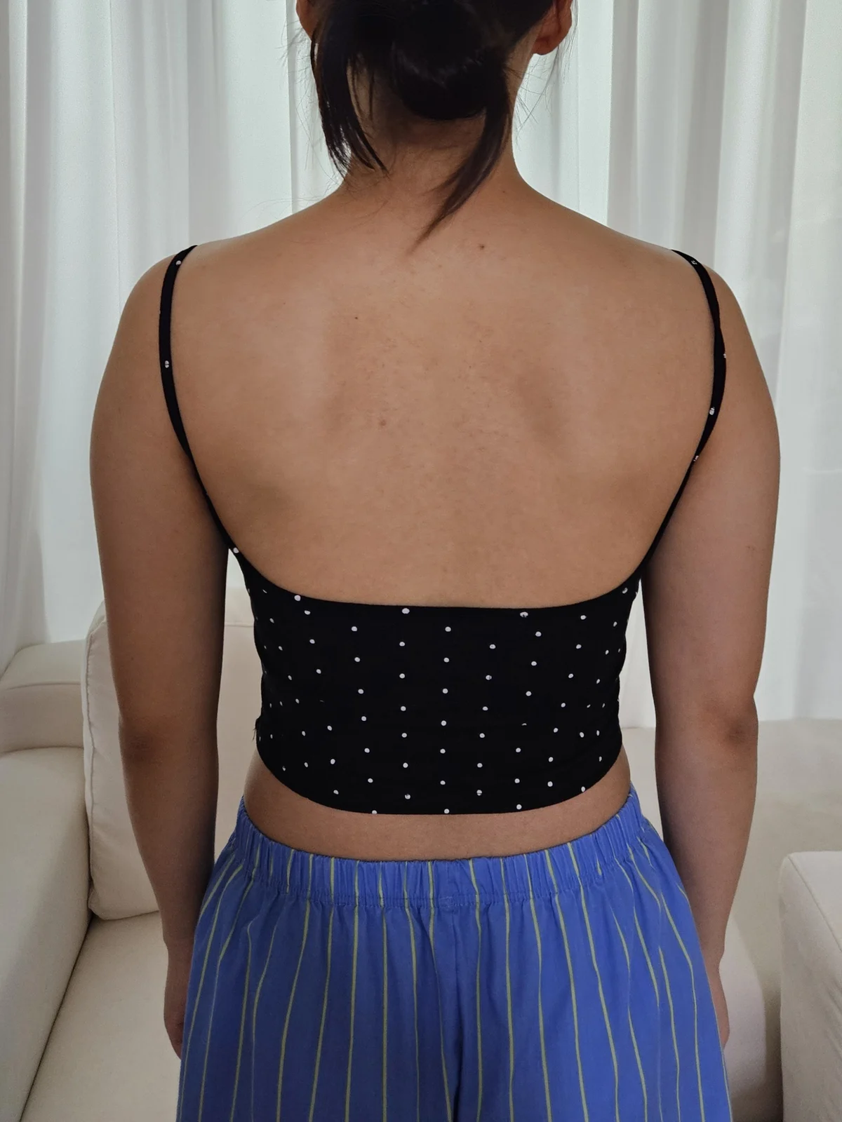 6 months after arm and accessory breast  - Arm Liposuction Before 2 - TheLINE Plastic Surgery