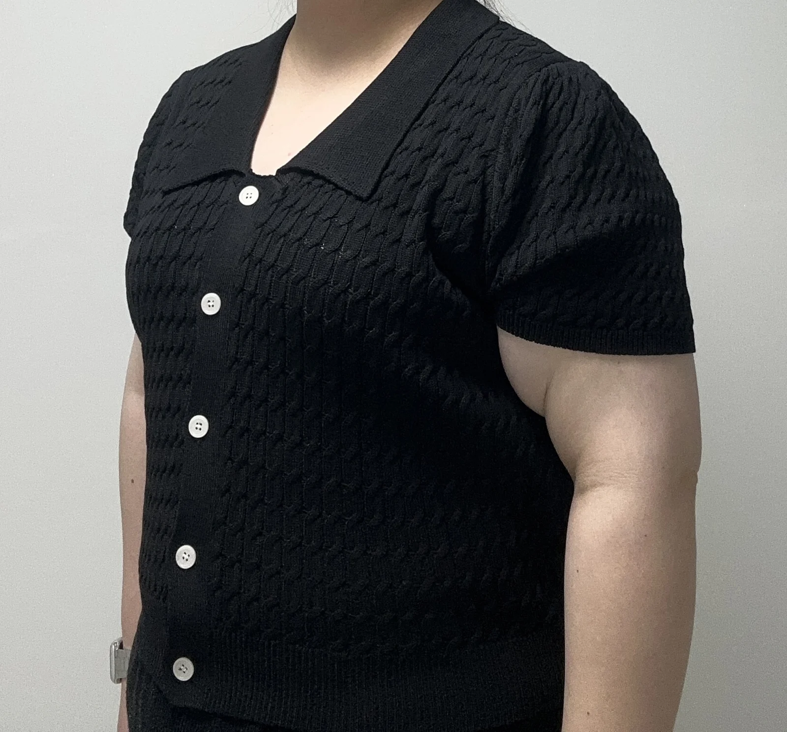 My review of 360-degree arm lipo, access - Body Contouring Before 2 - TheLINE Plastic Surgery