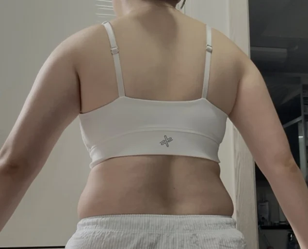 My 6-month review after arm surgery! - Arm Liposuction Before 2 - TheLINE Plastic Surgery