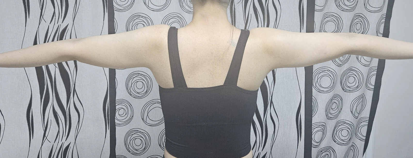 Arm liposuction review with Dr. Jaeho Ch - Arm Liposuction Before 2 - TheLINE Plastic Surgery
