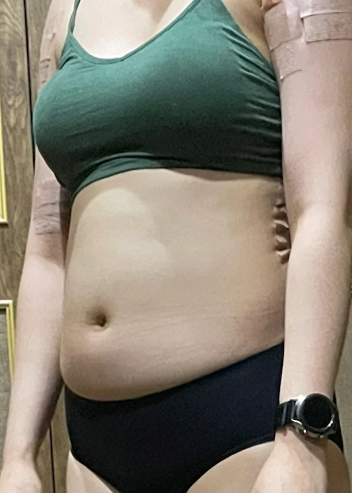 Posting my abdominal liposuction progres - Abdominal Liposuction (Upper Body) Before 2 - TheLINE Plastic Surgery
