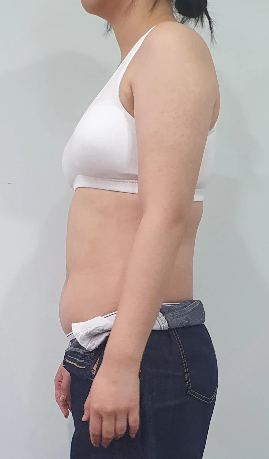 I had arm, abdomen and love handle lipos - Arm Liposuction Before 2 - TheLINE Plastic Surgery