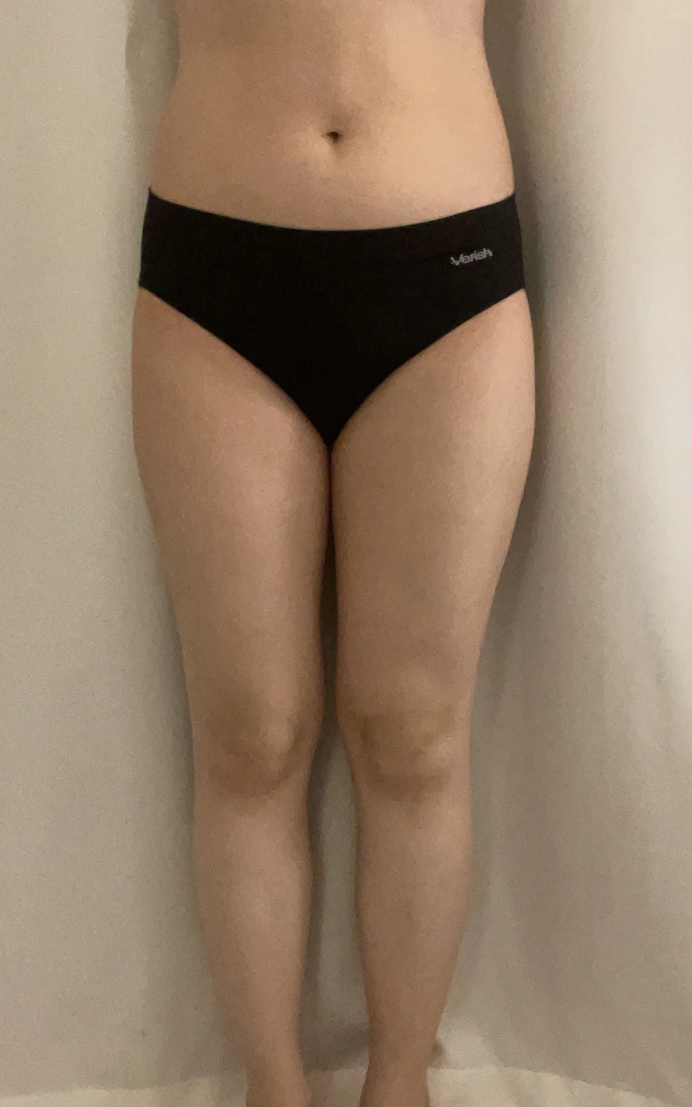 Thigh and knee lipo, hip fat grafting re - Thigh Liposuction (Lower Body) Before 2 - TheLINE Plastic Surgery