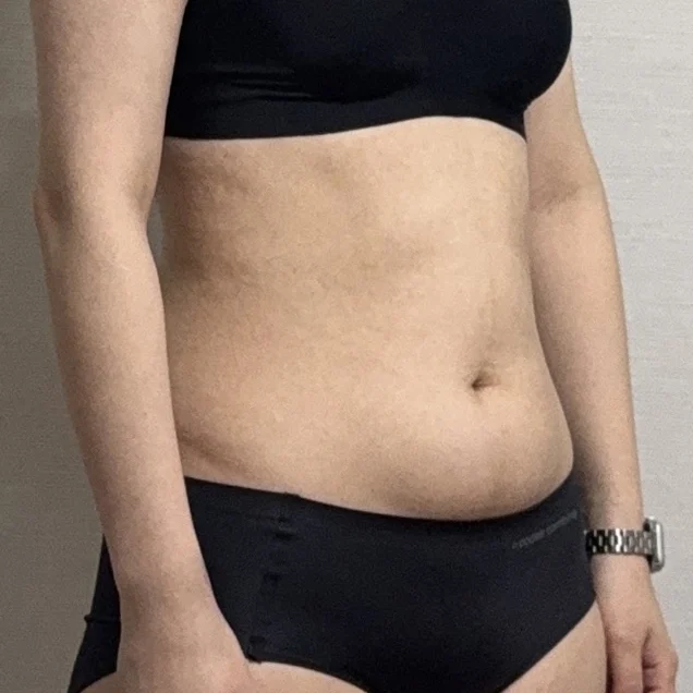 My abdomen and love handle liposuction r - Abdominal Liposuction (Upper Body) surgery Before photo - TheLINE Plastic Surgery