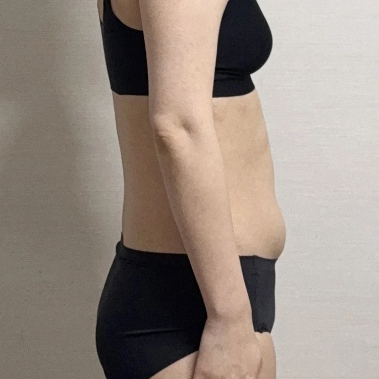 My abdomen and love handle liposuction r - Abdominal Liposuction (Upper Body) Before 2 - TheLINE Plastic Surgery