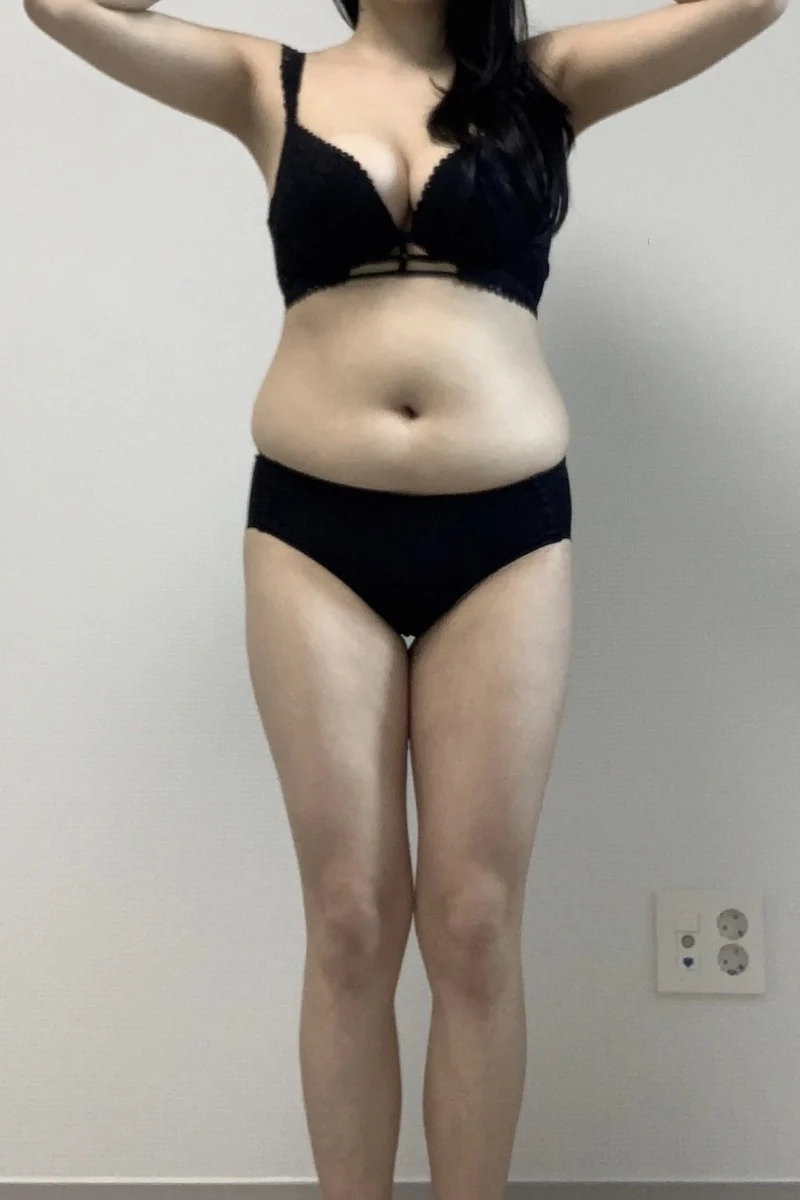 This summer I'm going to try a bikini!!! - Other Liposuction Before 2 - TheLINE Plastic Surgery