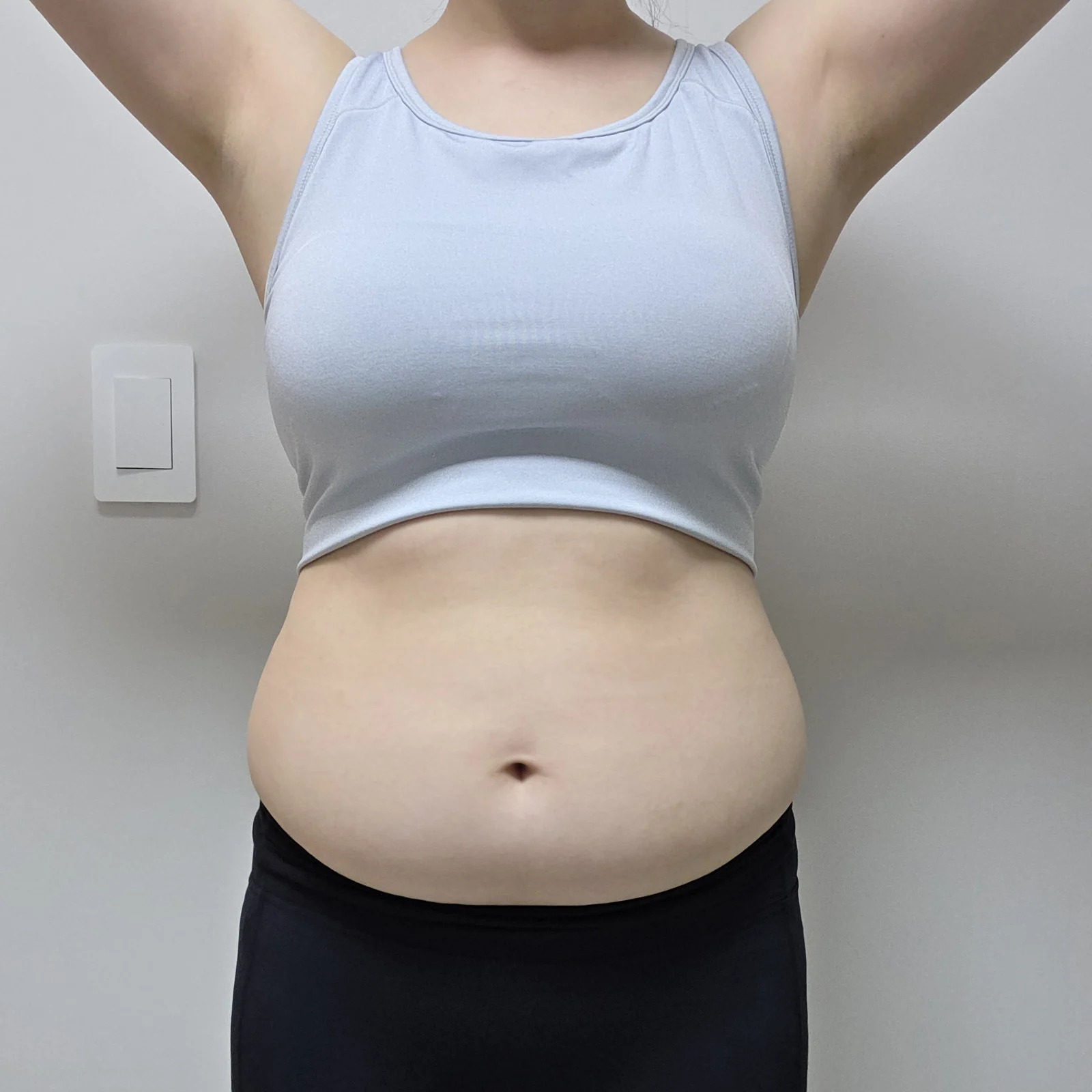 It is month 3 for my abdomen - Abdominal Liposuction (Upper Body) surgery Before photo - TheLINE Plastic Surgery