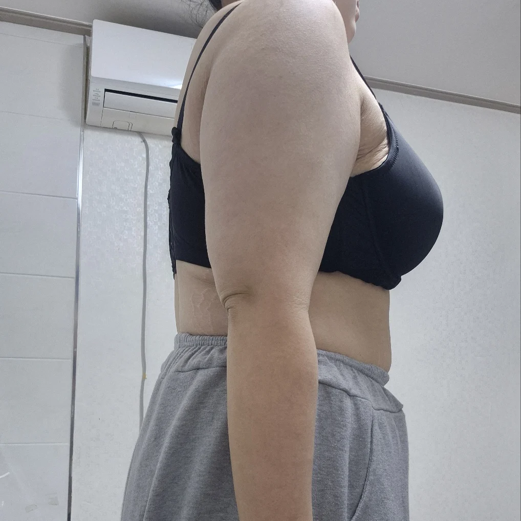 Six month arm liposuction review - Arm Liposuction Before 2 - TheLINE Plastic Surgery