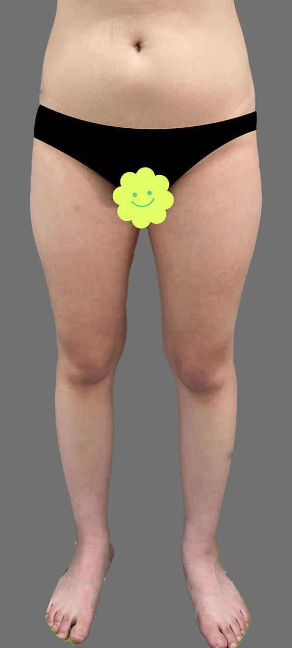 My inner and outer thigh and love handle - Abdominal Liposuction (Upper Body) Before 2 - TheLINE Plastic Surgery