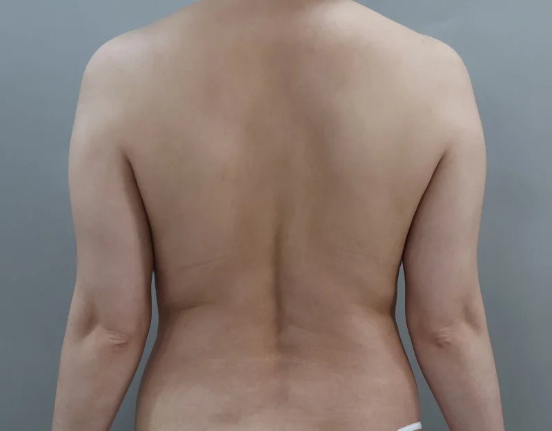 One month arm liposuction review - Arm Liposuction surgery Before photo - TheLINE Plastic Surgery