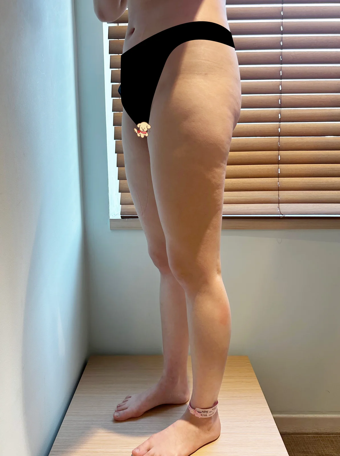 One month after thigh lipo and hip graft - Hip Fat Grafting Before 2 - TheLINE Plastic Surgery