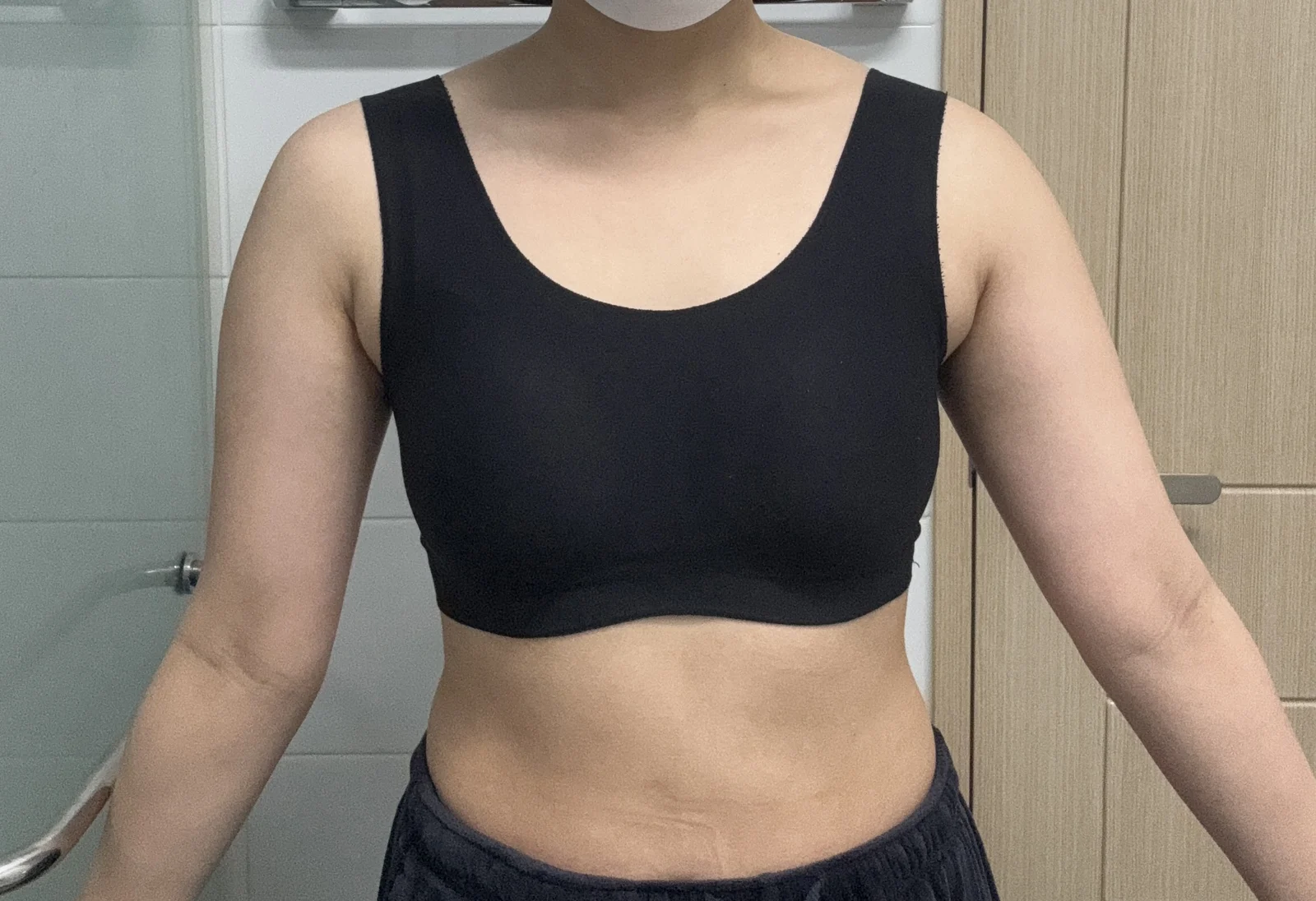 It is month 3 after my arm and axillary - Arm Liposuction surgery Before photo - TheLINE Plastic Surgery