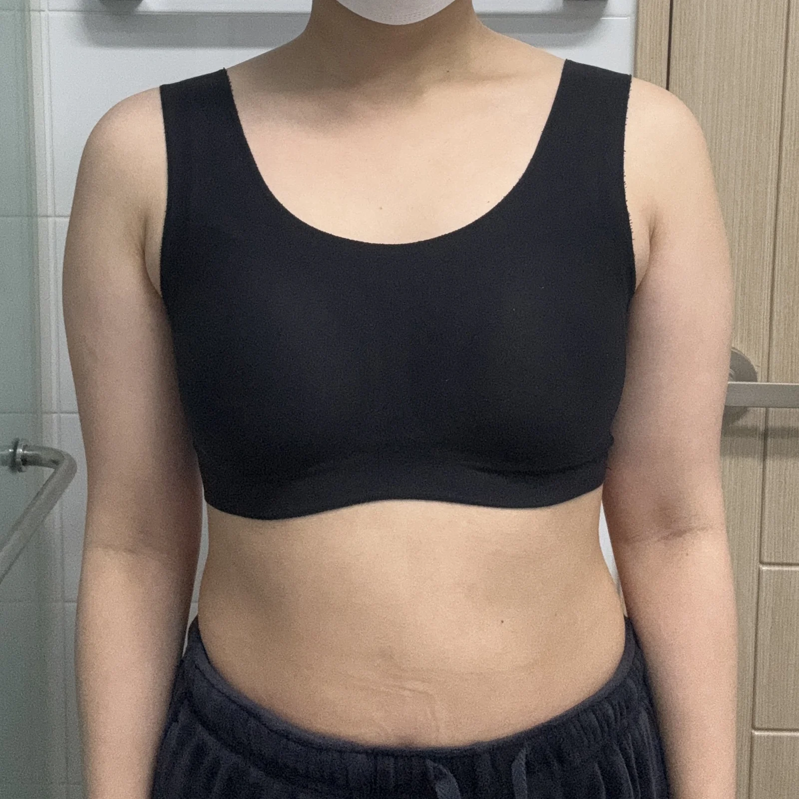 It is month 3 after my arm and axillary  - Arm Liposuction Before 2 - TheLINE Plastic Surgery