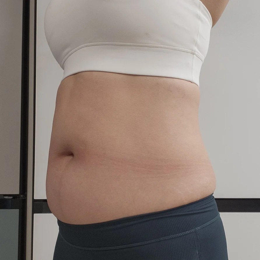 Abdomen & love handle liposuction review - Abdominal Liposuction (Upper Body) Before 2 - TheLINE Plastic Surgery